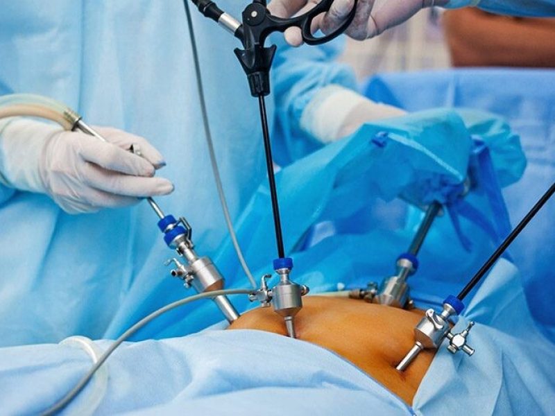 colecistectomia-369588077